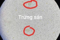 Thích ăn đồ tái sống, người đàn ông 64 tuổi bị sán lá gan gây tắc mật