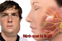 Nam bệnh nhân 41 tuổi bị biến chứng nặng do quai bị