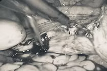 Nhiều năm không điều trị u xơ, người phụ nữ 44 tuổi phải cắt bán phần tử cung