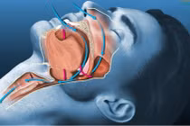 Ngưng thở khi ngủ dễ biến chứng tim mạch, cách gì phát hiện sớm?