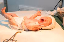 Phẫu thuật lấy thai thành công cho sản phụ bị rau tiền đạo trung tâm