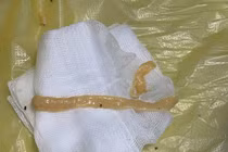 Sán dây gần 1 mét 'ngọ nguậy' trong đại tràng người đàn ông thích ăn đồ tái