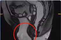 Tìm lại chất lượng cuộc sống cho phụ nữ bị sa sàn chậu