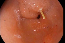 Sau 3 ngày nuốt tăm, bệnh nhân thủng dạ dày