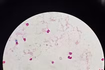 Ho sốt, đau đầu 2 ngày, người phụ nữ tại Hà Nội viêm não mô cầu nguy kịch