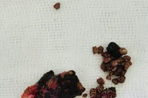 Lấy sỏi san hô kích thước lớn cho bệnh nhân 64 tuổi