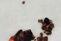 Lấy sỏi san hô kích thước lớn cho bệnh nhân 64 tuổi