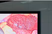 Cấp cứu thành công ca u nang buồng trứng xoắn ở trẻ 16 tuổi