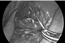 Phát hiện dị vật sau cơn đau bụng dữ dội, bệnh nhân viêm phúc mạc nguy hiểm