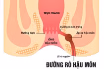 Chàng trai 25 tuổi đau đớn vì bệnh rò hậu môn nguy cơ ung thư