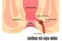 Chàng trai 25 tuổi đau đớn vì bệnh rò hậu môn nguy cơ ung thư