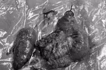 Đau vùng hạ sườn không ngờ phải cắt khối tá tụy do ung thư