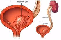 Sốt cao liên tục, trẻ 6 tháng tuổi nhiễn trùng tiểu nặng 