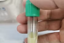 Viêm tụy cấp do không tuân thủ điều trị đái tháo đường