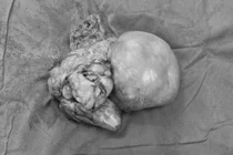 Phẫu thuật khối sarcoma mỡ sau phúc mạc khổng lồ ở bệnh nhân 76 tuổi