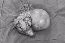 Phẫu thuật khối sarcoma mỡ sau phúc mạc khổng lồ ở bệnh nhân 76 tuổi