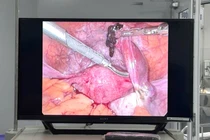 Cứu bệnh nhân 35 tuổi người Philippines vỡ thai ngoài tử cung nguy kịch