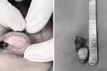 Phẫu thuật điều trị u bì kết giác mạc to trên mi người đàn ông 33 tuổi