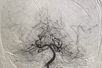 Hồi sinh bé trai nguy kịch do thuyên tắc mạch máu não