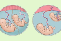 Cứu trẻ song thai sinh non nặng chưa đến 1 kg viêm ruột hoại tử nặng 