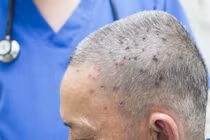 Người đàn ông 61 tuổi sốc phản vệ nặng do bị ong đốt 117 mũi