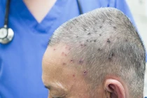 Người đàn ông 61 tuổi sốc phản vệ nặng do bị ong đốt 117 mũi