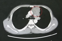 Tìm lại hy vọng sống cho thanh niên 39 tuổi hôn mê, co giật do nhược cơ