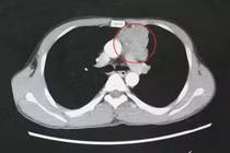 Tìm lại hy vọng sống cho thanh niên 39 tuổi hôn mê, co giật do nhược cơ