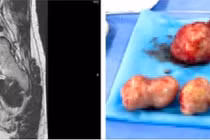 Đau bụng, ra máu âm đạo, bệnh nhân phát hiện đa u xơ tử cung phức tạp