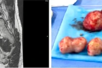 Đau bụng, ra máu âm đạo, bệnh nhân phát hiện đa u xơ tử cung phức tạp