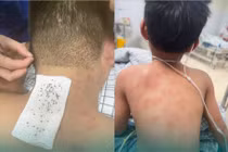 Hai cha con sốc phản vệ do tìm tổ chim bị ong đốt