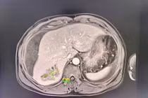 Bụng chướng căng người bệnh nguy kịch do áp xe gan vỡ chảy máu ổ bụng