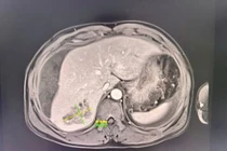 Bụng chướng căng người bệnh nguy kịch do áp xe gan vỡ chảy máu ổ bụng