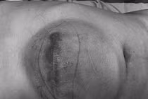 Chủ quan không đi khám u thành bụng tái phát đường kính 20cm