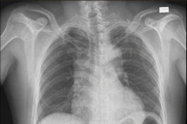 Đau ngực như dao đâm, người đàn ông bị lóc tách động mạch chủ nguy kịch