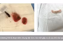 Kịp thời cứu trẻ 3 tuổi nuốt đoạn kẽm nhung dài 2cm