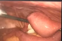 Nhiều người già tắc ruột do bã thức ăn, biến chứng vỡ ruột, hoại tử