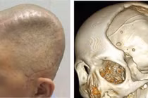 Bảo vệ não bộ, phục hồi thần kinh bằng công nghệ 3D tái tạo hộp sọ