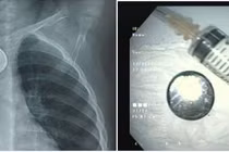 Dị vật cực nguy hiểm gây loét thực quản trẻ 18 tháng