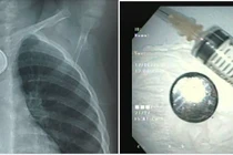 Đi khám ho sốt không ngờ pin cúc gây loét thực quản