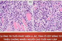 Cụ ông 70 tuổi phát hiện u ác tính cột sống từ đau lưng