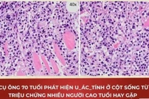 Cụ ông 70 tuổi phát hiện u ác tính cột sống từ đau lưng