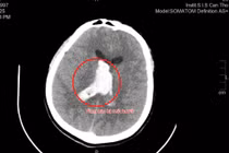 Thầy giáo trẻ bị đột quỵ được cứu sống trong gang tấc