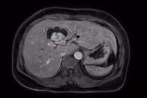 Phát hiện đồng thời hai ung thư ở đại tràng và đường mật