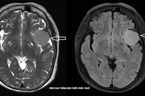 Phẫu thuật thành công u màng não lớn cho cụ bà 73 tuổi 