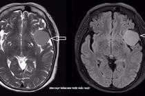 Phẫu thuật thành công u màng não lớn cho cụ bà 73 tuổi 