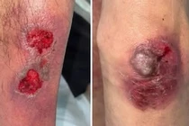 Tổn thương gan thận, thần kinh vì ngộ độc thuốc methotrexate