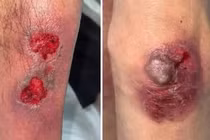 Tổn thương gan thận, thần kinh vì ngộ độc thuốc methotrexate