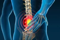 Đau lưng không ngờ phát hiện bệnh máu ác tính, đa u tủy xương