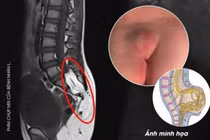 Dị tật tủy sống bẩm sinh để 10 năm không đi khám